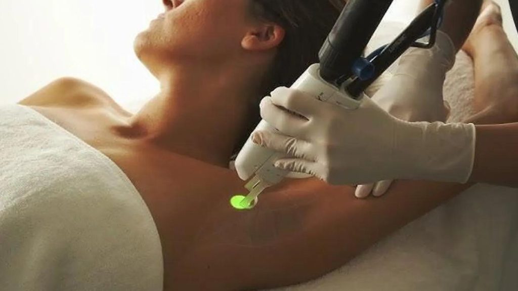 epilation définitive : les différentes techniques